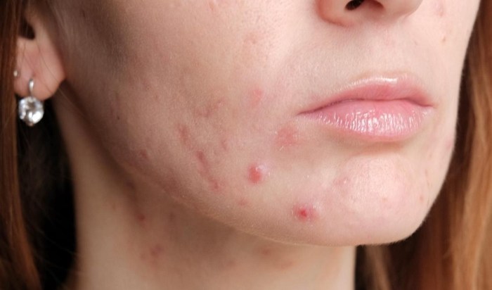 Acne Algorithm from the Global Alliance algorithm to improve outcomes ... Acne Treatments: Tackling Skin Concerns Worldwide